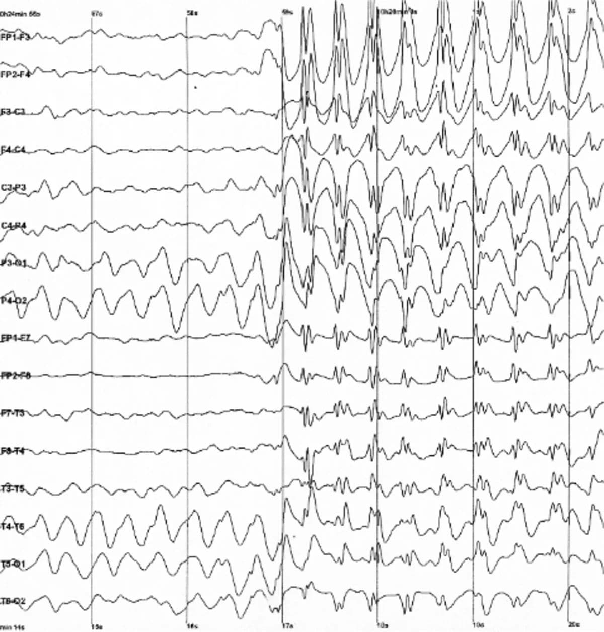 Spike and wave discharges monitored with EEG 