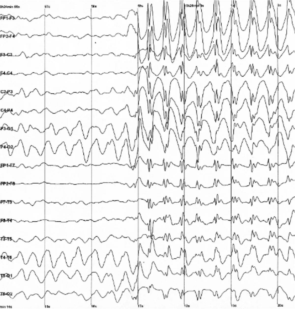 Spike and wave discharges monitored with EEG 